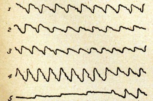 Five sphygmograph lines.